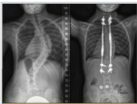 Two spinal X-rays side by side: on the left, a spine with a pronounced scoliotic curve; on the right, the same spine straightened with vertical corrective rods and screws.