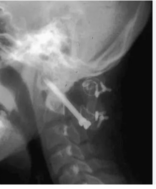 2D lateral X-ray of the spine with a bright cage implant on the superior cervical vertebrae.
