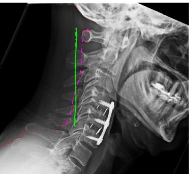 3D X-ray of the cervical spine with triangular implants shown digitally.