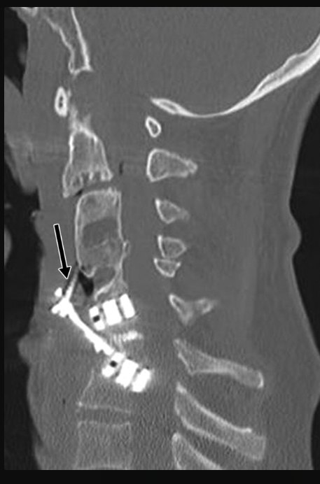 2D CT slice of a vertebra with an arrow pointing to a spine implant.