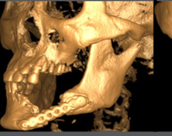 3D CT reconstruction of the cervical spine and jaw in tan/orange color.