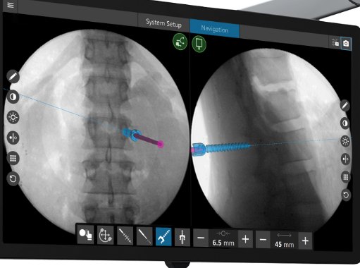 2D X-ray of the spine with a blue digital instrument showing its real-time location.
