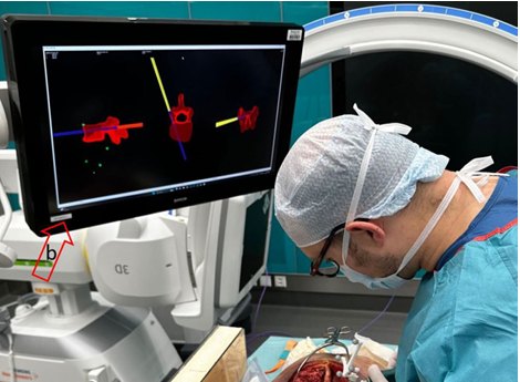 Operating-room photo showing X23D's red 3D spine model on an overhead screen with a yellow tracked instrument.