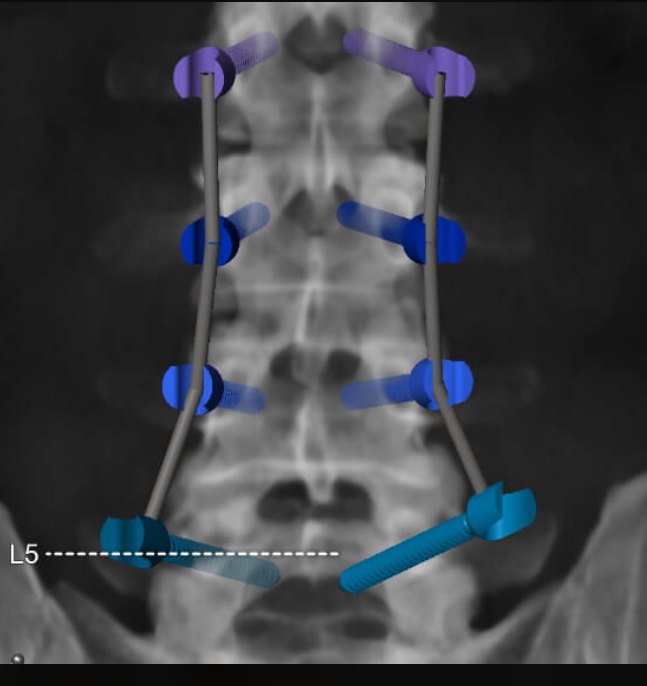 3D X-ray of the lumbar spine with blue and purple implants displayed digitally in real time.