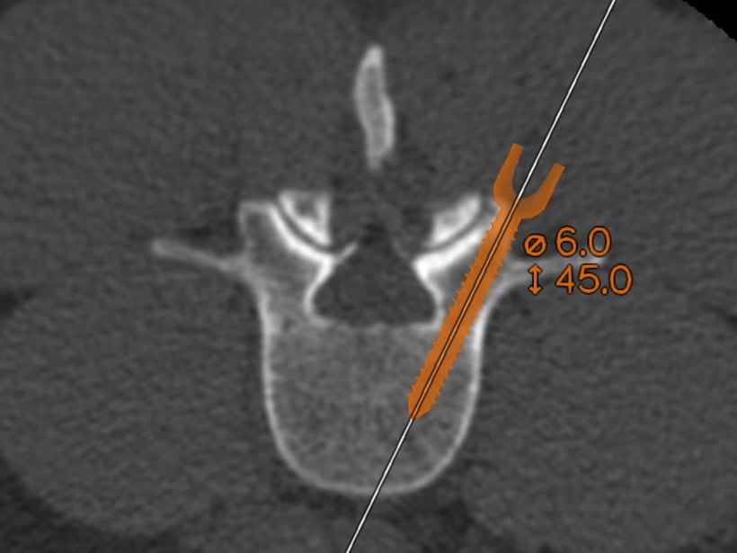2D CT of a vertebra with an orange implant marking the current screw location during insertion.