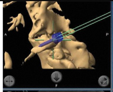 3D CT of the cervical spine with a blue digital instrument and green trajectory line.