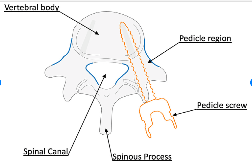 Labeled overhead illustration of a correct pedicle-screw insertion showing the vertebral body, pedicle region, spinal canal, spinous process, and pedicle screw.