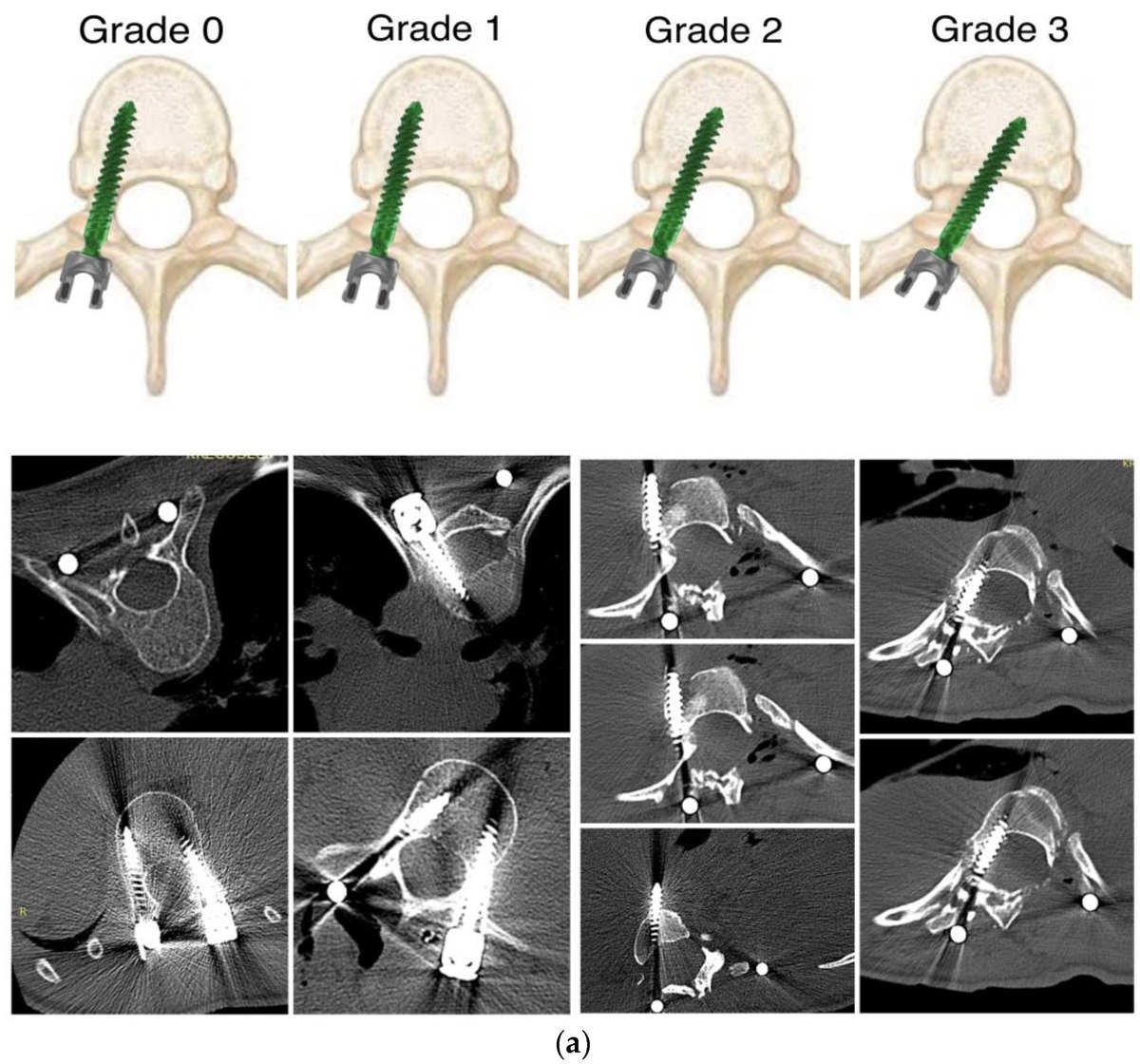 Grid of anatomical illustrations showing pedicle-screw breach severity from Grade 0 to Grade 3, with the screw deviating progressively further from the pedicle midline.